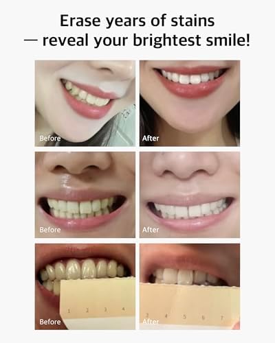 Live Orals PureDia Teeth Whitening Kit - Gel & Mouthpiece Set, Hydrogen Peroxide, Dentist Formulated for Sensitive Teeth, 28 Treatments.