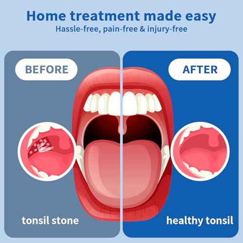 Upgraded Electronic Tonsil Stone Remover，10 in 1 Tonsil Stone Removal Kit，Tonsil Stone Vacuum with Built-in Blue Light，Easy to Use, Fight Bad Breath, Instant Suction