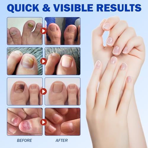 Nail Patches For Toenails & Fingernails – 21Pcs Nail Repair Stickers For Damaged Nails, Ingrown & Discoloration Care, Random (2 pack)
