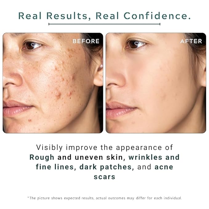 Zinc 1% + Hyaluronic Acid 10% - Advanced Anti-Aging Serum for Face -Balance Oily Skin, Minimizes Pores & Smooths Fine Lines - Deep Hydration Serum for All Skin Types - 1 Fl Oz