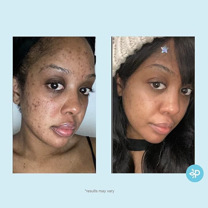 Salicylic 10% Gel Peel, Breakout and Pore Minimizer and Cleanser, 15-30 Full Facial Chemical Peels, 1 fl oz. e, 30 mL – Perfect Image