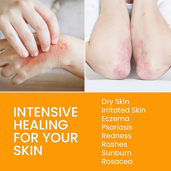 25-in-1 Healing Moisturizing Cream Dry Irritated Itchy Skin Relief - Soothes Nourishes Body Scalp Hands, Natural Moisturizer for Eczema Psoriasis Dermatitis, Adults Kids